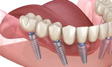 Texas Implant Clinic All On Full Mouth Dental Implants Implant