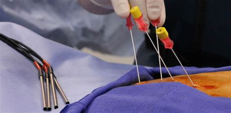 What Is Radiofrequency Ablation Learn More At