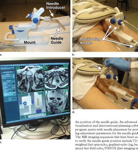 Figure 3 From Imaging Guided Prostate Biopsy Conventional And Emerging