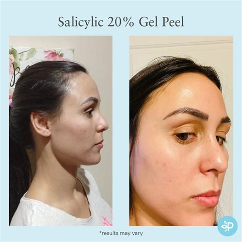 Salicylic 20 Gel Peel Chemical Peel Professional Skin Care Products