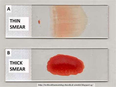 Differences Between Thick Blood Smear And Thin Blood Smear, 43% OFF