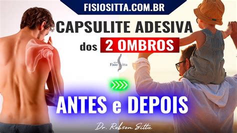 Capsulite Adesiva Do Ombro Congelado Bilateral Tratamento Antes Depois