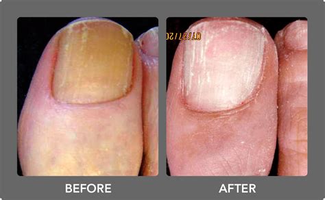 Laser Nail Fungus Removal: Laser Nail Fungus Cure San Diego