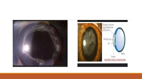 Posterior Capsular Opacification Pptx