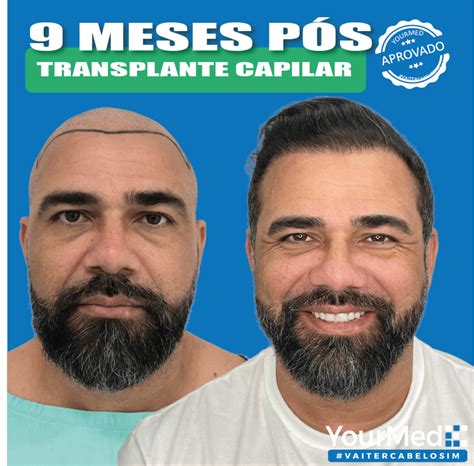 Dicas Para Melhorar A Apar Ncia Conhe A O Transplante Capilar Yourmed