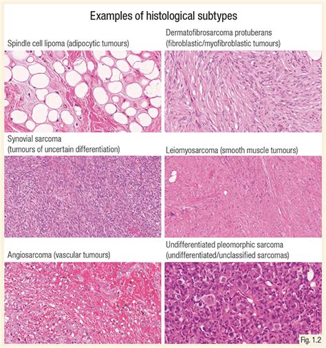 Fibrosarcoma Histology