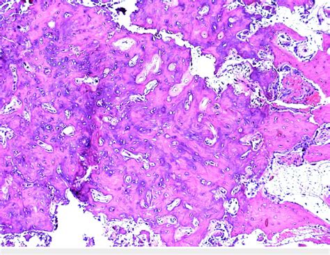 The Classic Appearance Of The Nidus Of The Osteoid Osteoma Composed Of Download Scientific