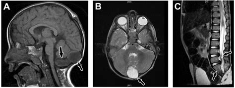 Caudal Regression Syndrome A Brain Mri Showing 2 Cystic Structures At