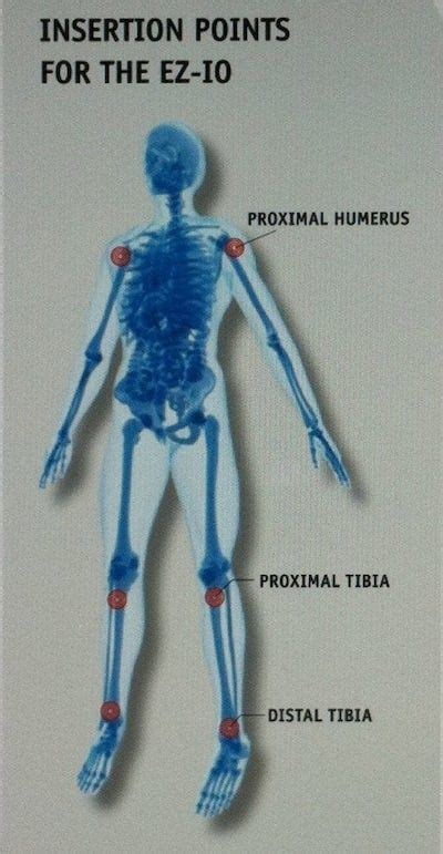 Seizing and No Access • LITFL • Ruling the Resus Room