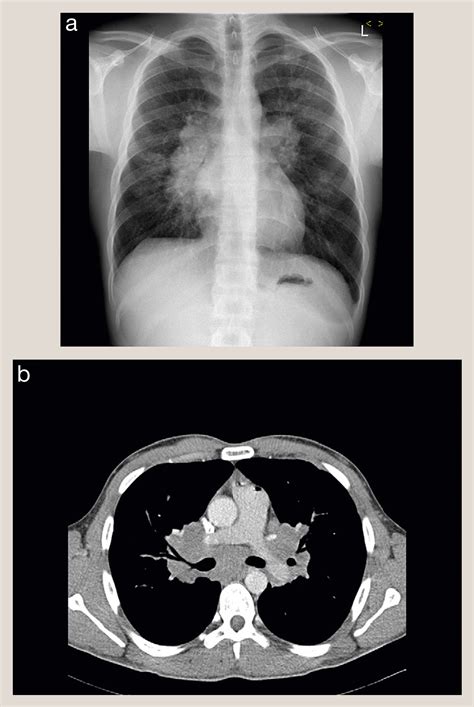 Pulmonary Sarcoidosis Medicine