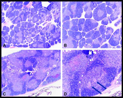 A B Thymectomy Revealing Thymic Hyperplasia Lobulated Thymic