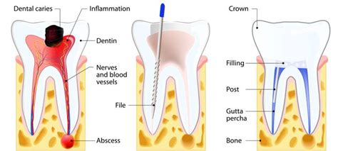 All About Root Canal Treatment Explained Leading Dental Clinic In