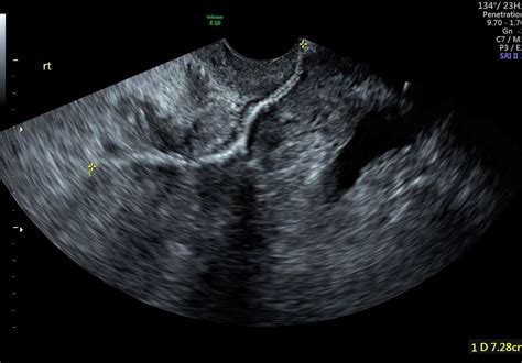 Large Pussy Mounds Aka Massive Mons Pubis Pics Xhamster My XXX Hot Girl