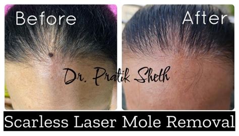 Laser Mole Removal In Rajkot Safe And Effective Treatment