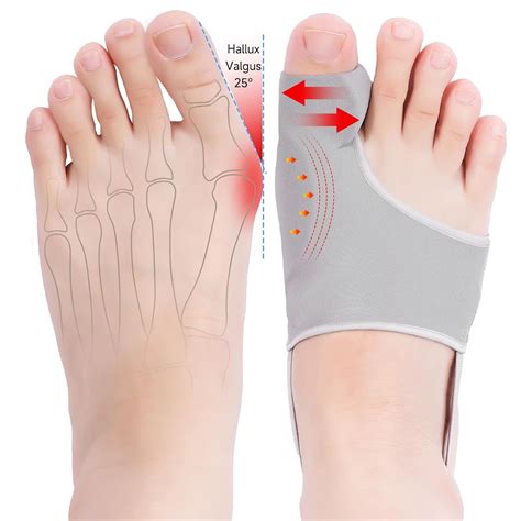 Hyggear Big Toe Bunion [Hallux Valgus] Corrector – HYGGEAR