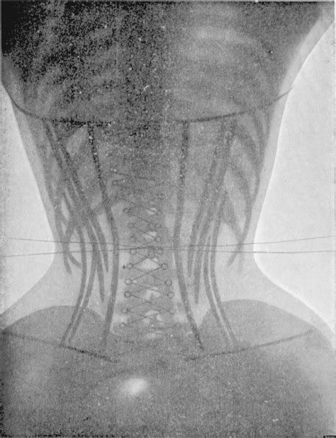 Corset Pictures X Rays Of Women Before And After Make Us Extremely Uncomfortable Huffpost