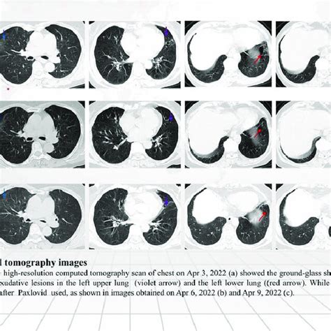 Chest Computed Tomography Images After Admission The High Resolution Download Scientific