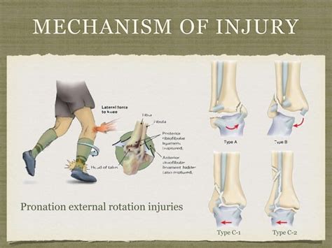 Syndesmotic injury mechanism and treatment subject review | PPT