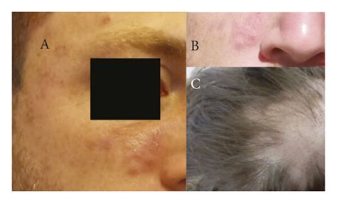 24 Year Old Male Patient 62 Days Following Vaccine Administration A