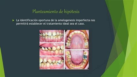 Amelogenesis imperfecta anomalía dental PPT