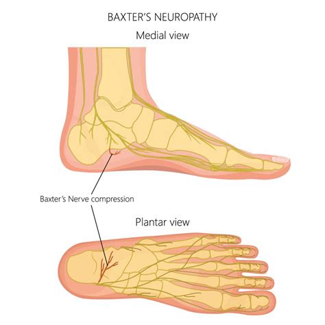 Bottom Of the Foot Pain:[ Causes, Symptoms & Best Treatment 2020 ]