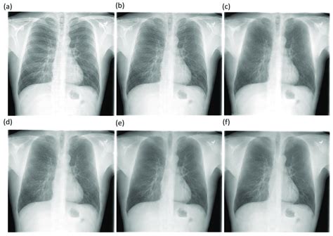 Bone Suppressed Cxr Images Predicted By The Proposed Models Using A Cxr