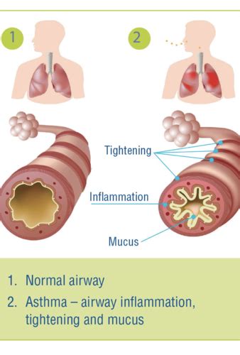 Asthma Flashcards Quizlet