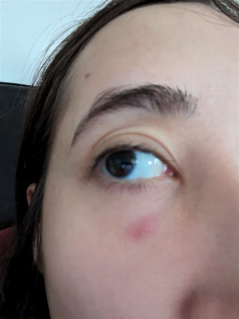 Big hard pimple under eye : r/acne