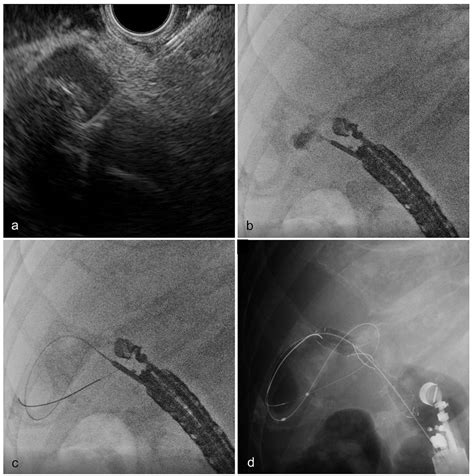 Strategy Comparison Of Endoscopic Ultrasound Guided Gallbladder