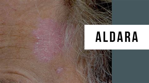 Earliest Stage Treatment Of Actinic Keratosis With, 52% OFF