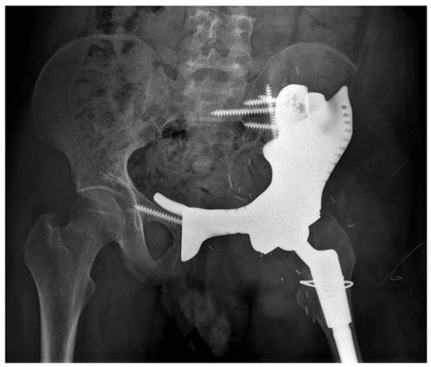 Jcm Free Full Text Outcomes And Complications Of Pelvic