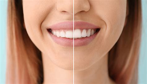 Cosmetic Laser Gum Treatment Atlanta Dental Center Atlanta Ga Atlanta Dental Center