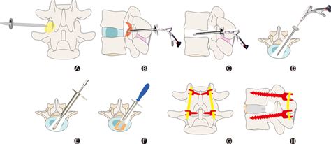 Schematic Diagram Of The Key Procedures Of Endo Tlif Surgery A