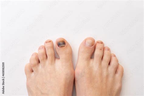 Subungual Hematoma Present Under The Toenail Of The Hallux More