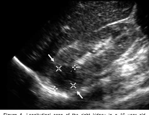 Glomerulonephritis Ultrasound