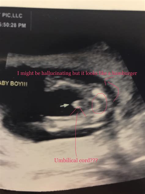 Umbilical Artery Ultrasound