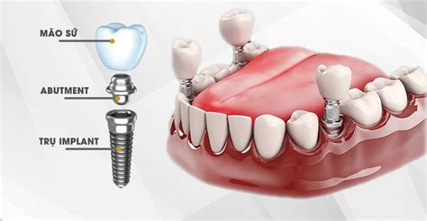 Những lưu ý sau khi cấy ghép Implant