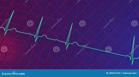 Ein Ekg Mit Av Block 3d Abbildungen Des 2 Grads Stock Abbildung