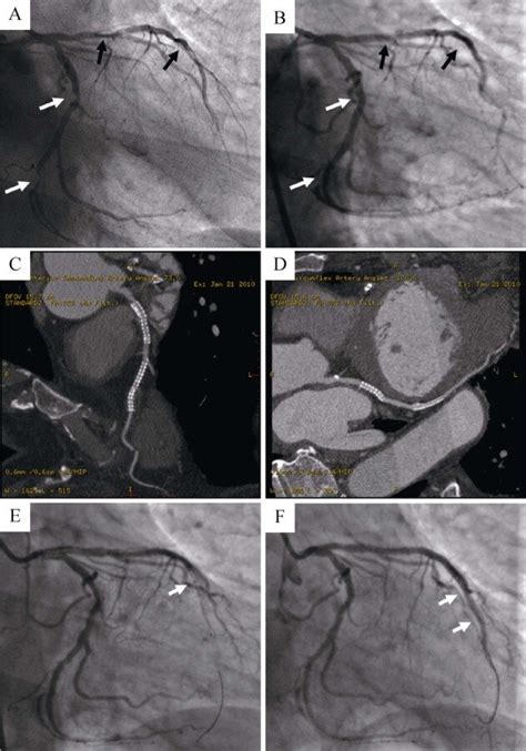 A Baseline Coronary Angiography In Right Anterior Oblique Caudal