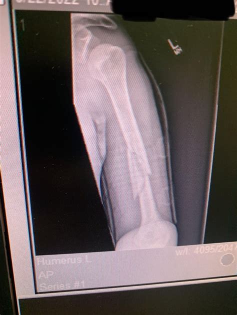 Spiral Fracture Mid Shaft Of My Left Humerus Currently 4 Weeks Since