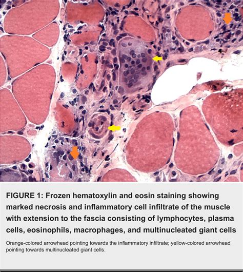 Figure 1 From Granulomatous Myositis Associated With Myasthenia Gravis