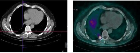 68Ga DOTATOC PET CT Scan A Computed Tomography CT And B Fused