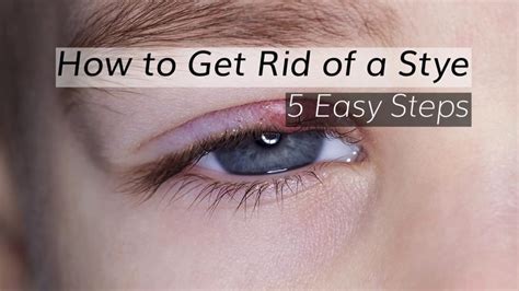 Eye Stye Treatment How To Get Rid Of A Stye In 5 Steps YouTube