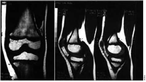 Sinovitis De Rodilla Condromalacia Caso CONAMED