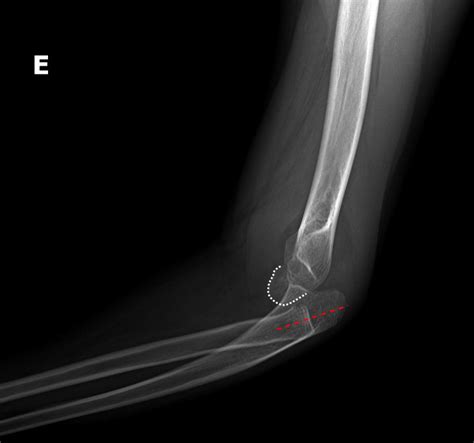 Radial Head Dislocation With Ulnar Bowing Image Radiopaedia Org