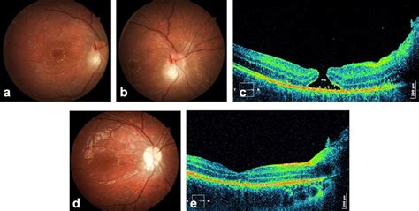 Ae Panuveitis Including Findings Of Neuroretinitis In A 10 Year Old