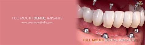 Full Mouth Dental Implants Treatment Cost In India Cosmodent India