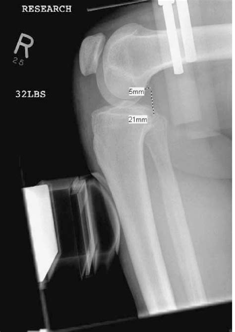 Radiographic Stress Test Using The Telos Ga Ii Stress Device Download Scientific Diagram