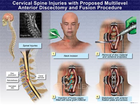 Cervical Spine Injuries With Proposed Multilevel Anterior Discectomy