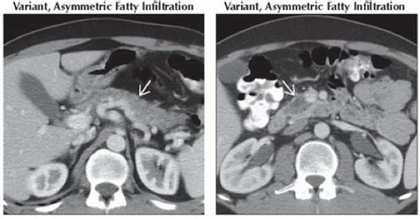 DA12 DB1 Atrophy Or Fatty Replacement Of Pancreas FFU4 Abdominal Key